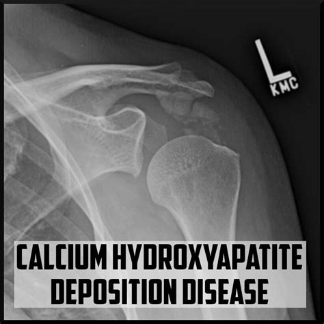 Hydroxyapatite Deposition Disease Icd 10